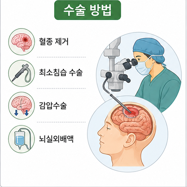 뇌출혈 치료에 사용되는 혈종 제거와 최소침습 수술, 감압수술, 뇌실외배액 방법을 정리한 이미지