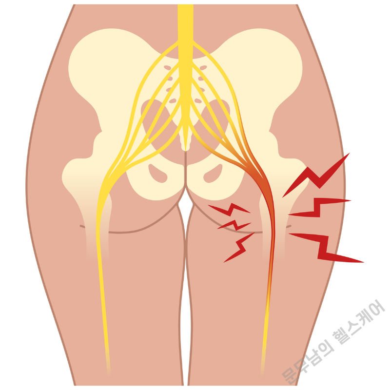 허리 디스크 다리 저림 증상 원인