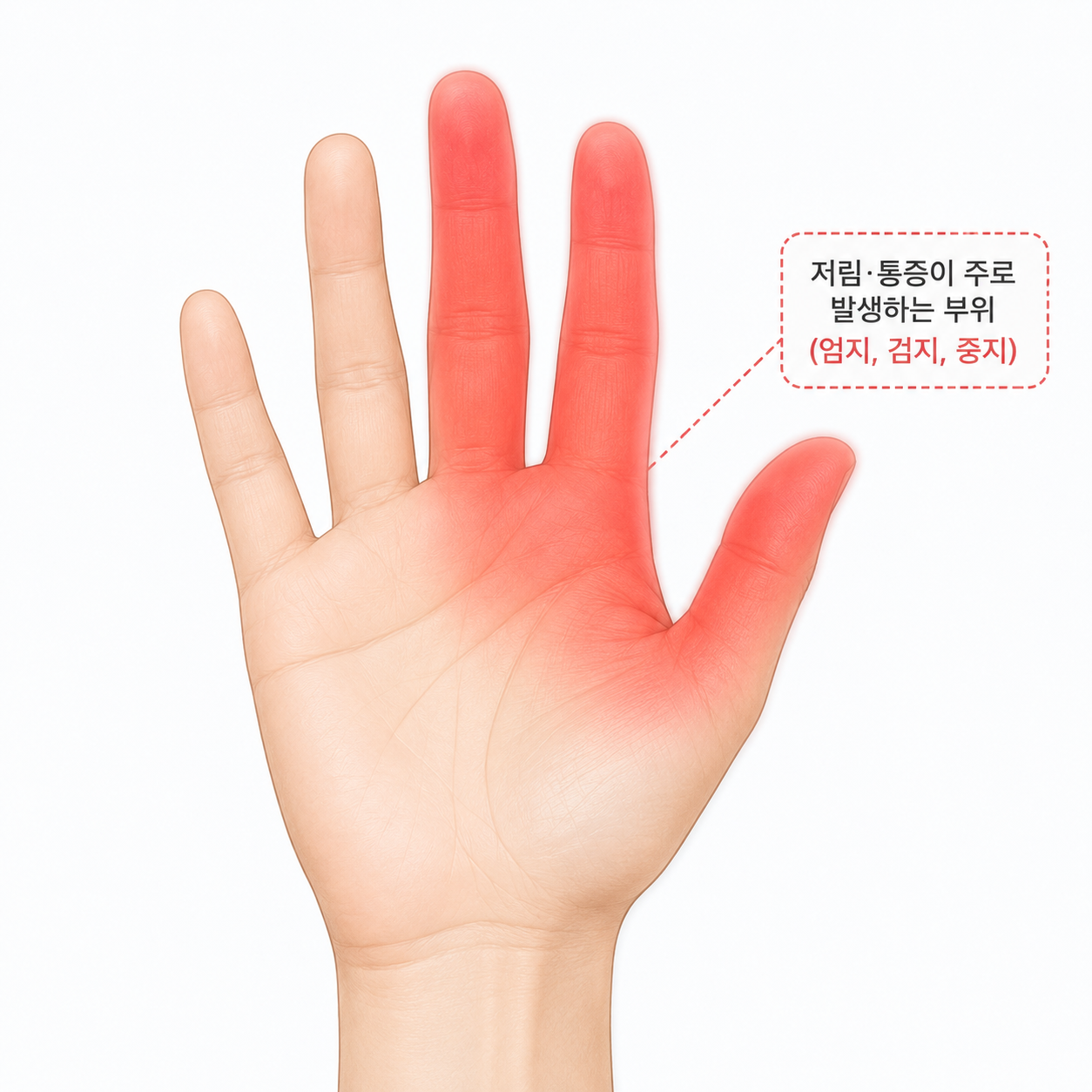 손가락저림손목터널증후군