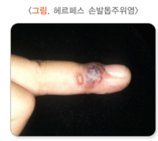 손발톱헤르페스-단순포진