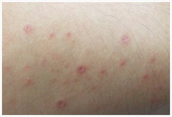 빈대 물린자국 : 빈대 퇴치법, 증상, 예방법