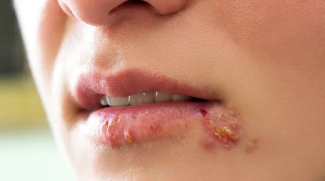 입술 헤르페스 원인