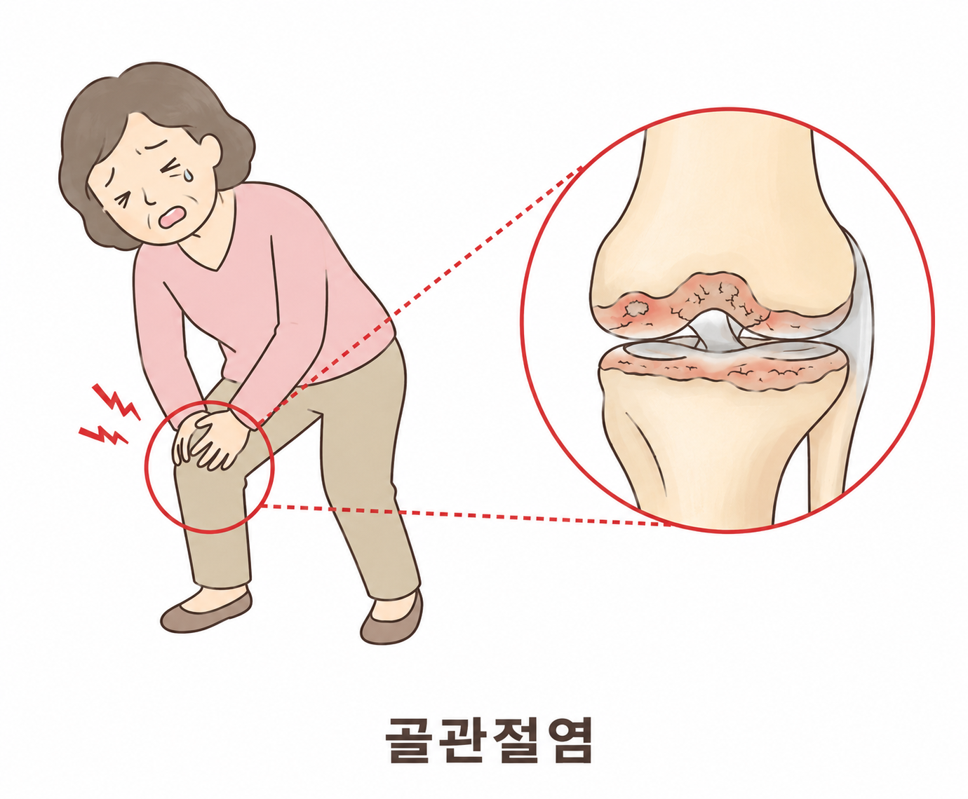 골관절염 이미지