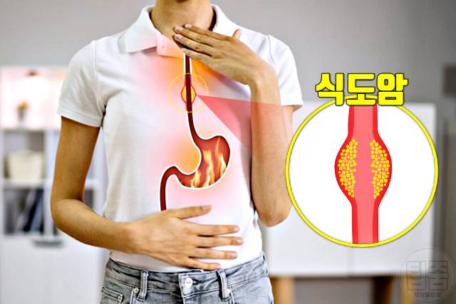 식도암 증상 속쓰림 식도암초기증상