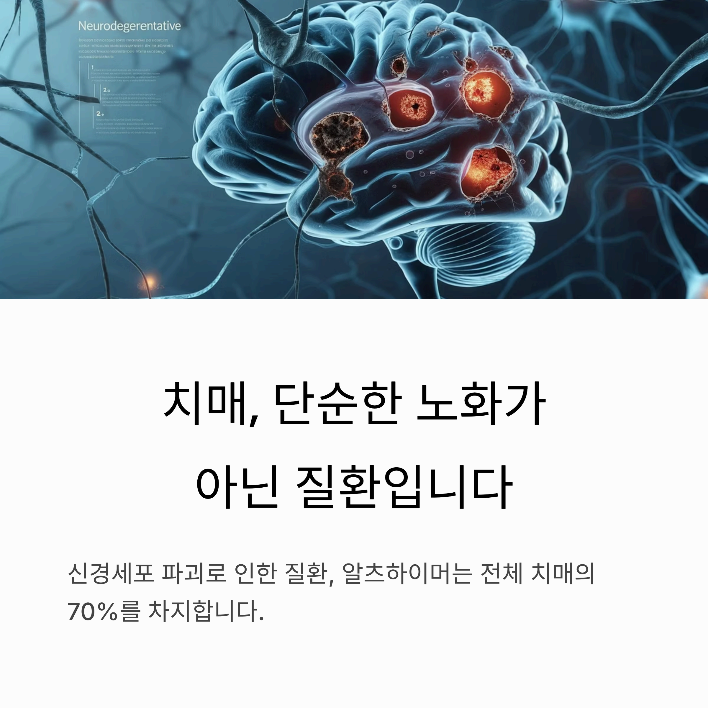 치매, 단순한 노화가 아닌 질환입니다.