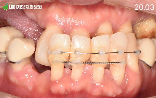 서울치과 이수역 내이처럼 전체 임플란트