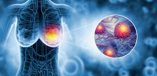 유방암 초기증상과 예방법