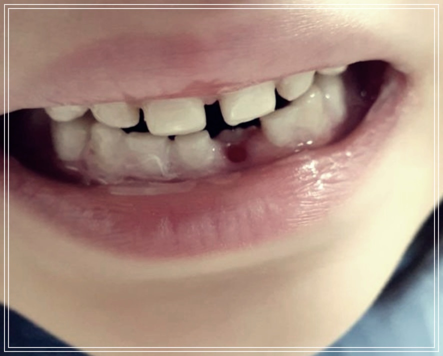 설측 맹출 생기는 이유? 원인 해결방법.