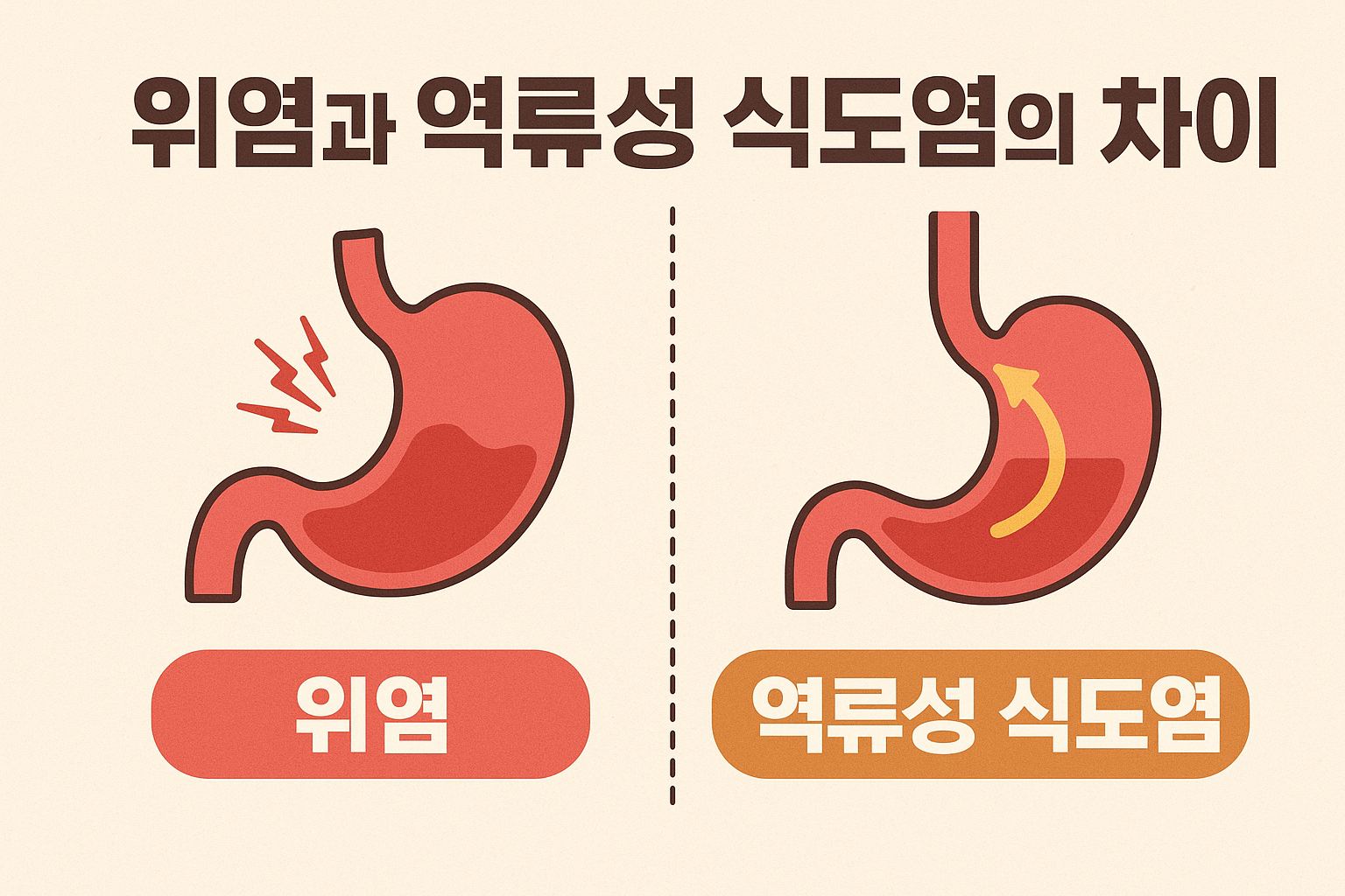 위염과 역류성 식도염 차이, 정확히 알고 대처하세요