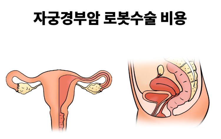 자궁경부암 로봇수술 비용