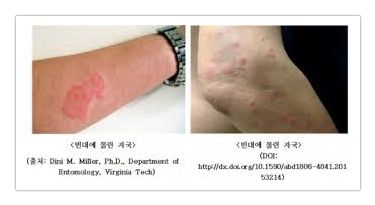 빈대물린자국