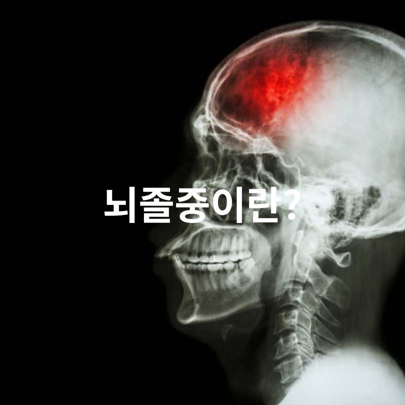 뇌졸중 골든타임 3시간의 중요성