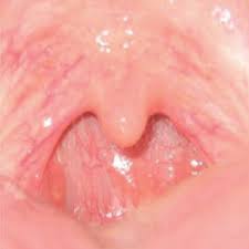 목에 이물감 느껴지는 증상