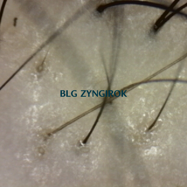 탈모 극복프로젝트 - 피나모아 복용 - 정수리와 이마사이 두피사진 모습이다.