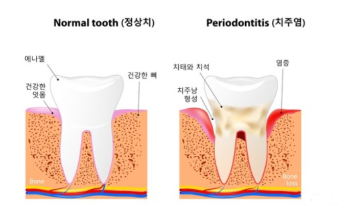 치주염 및 치아 단면도
