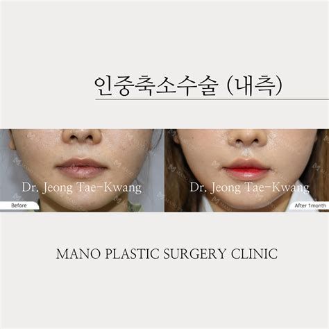 인중 축소 수술