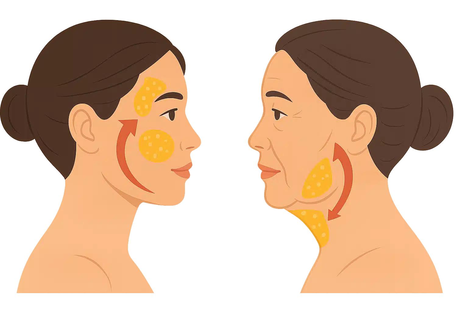 젊은 얼굴은 위쪽 볼과 관자놀이에 지방이 집중, 나이 든 얼굴은 아래쪽(불독살, 이중턱)에 지방이 쌓인 모습