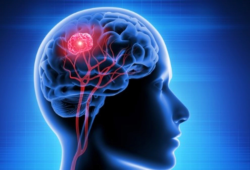 뇌암 초기증상