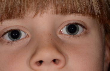 여자아이 콧구멍