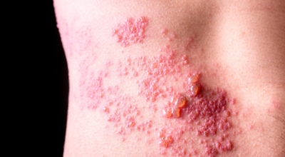 대상포진이미지