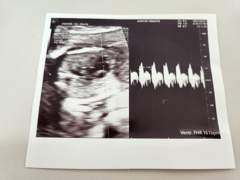 2차 정밀 초음파