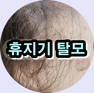 휴지기 탈모,
탈모 치료 비용,
모발이식 후기,
정수리 탈모 남자,
여성 탈모 치료,
탈모 샴푸 추천,
두피케어 약초,
탈모 예방 자연약초,
M자 탈모 남성,
출산 후 탈모 관리,