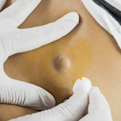 피지낭종의 원인, 증상, 치료법 및 주의사항