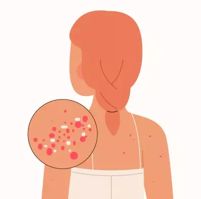 대상포진 초기증상 예방접종 비용