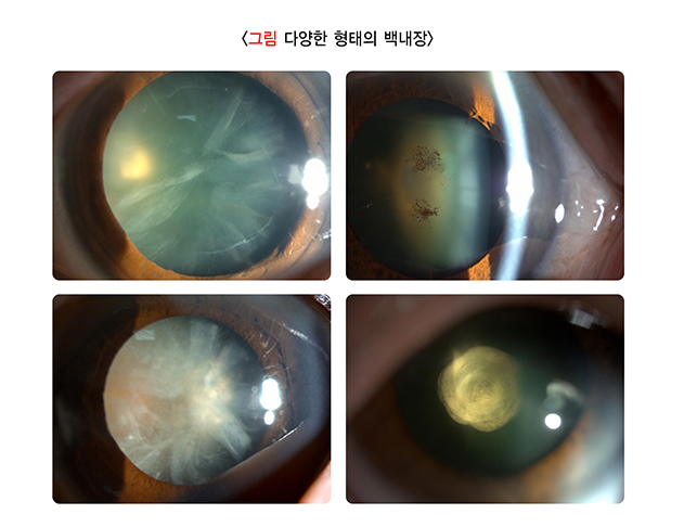 다양한 형태의 백내장