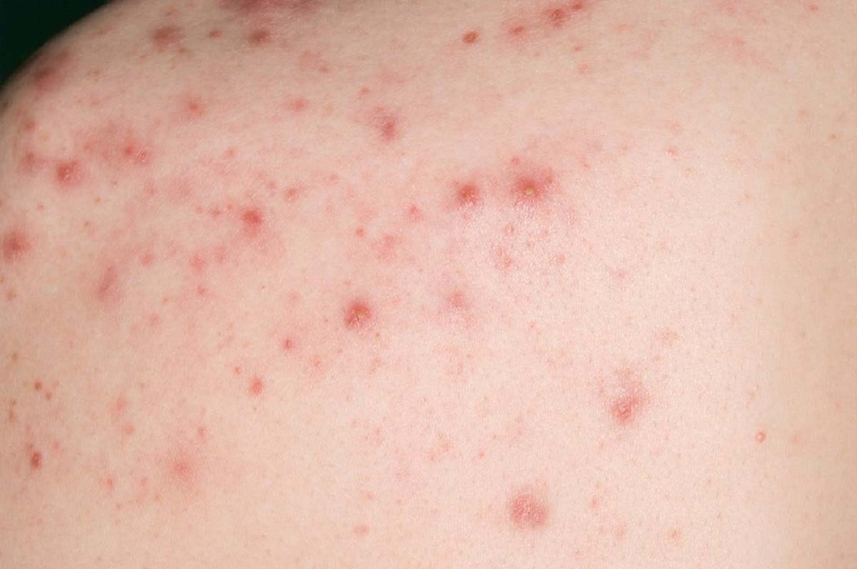 가드름 등드름 원인과 없애는 방법(시술X)