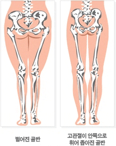 벌어진골반-좁아진골반