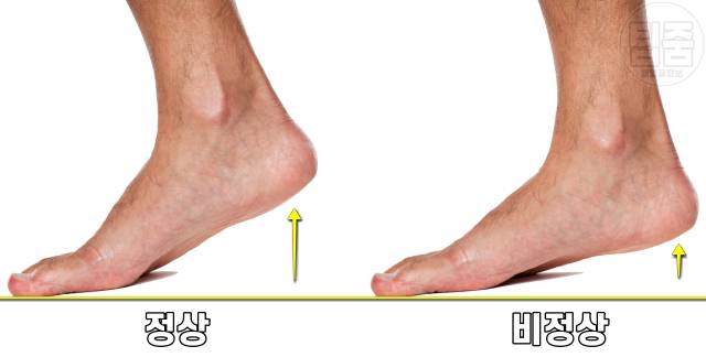 허리디스크 증상 자가진단 까치발