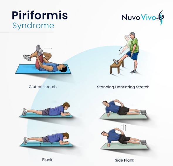 이상근 증후군 스트레칭