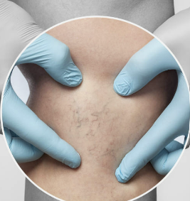 하지정맥류 증상 좋은운동 치료방법 총정리(최신)