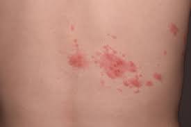 대상포진 초기증상 10가지