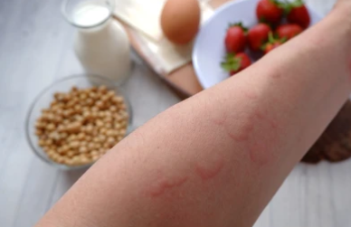 대상포진에 좋은 음식