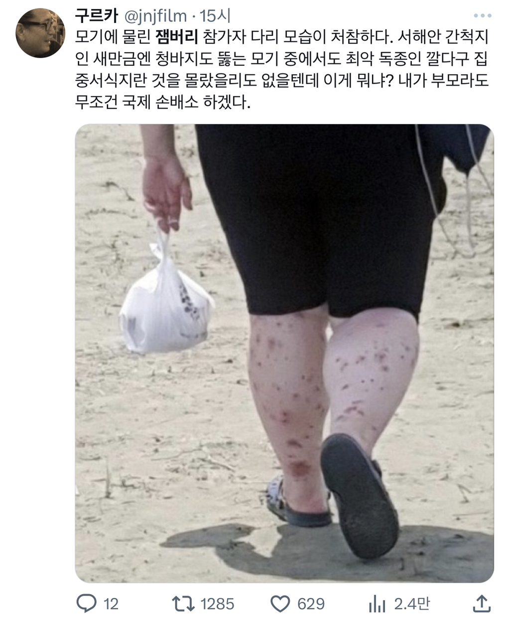 잼버리 참가자의 모기 물린 다리