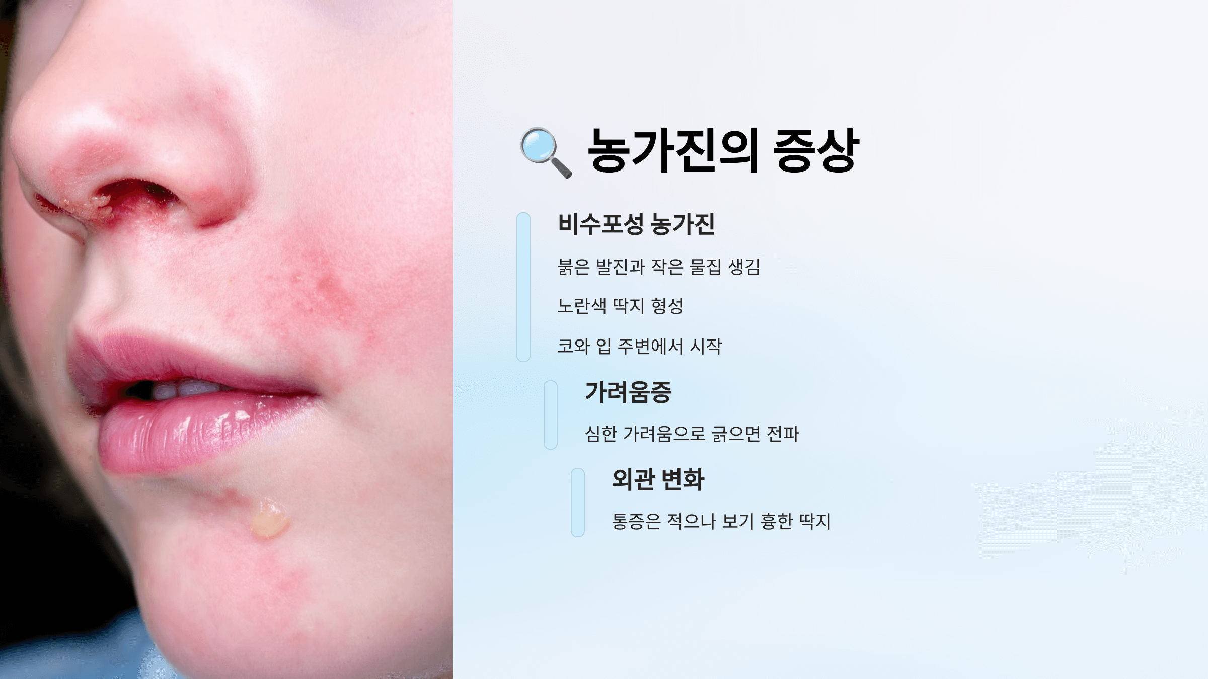 농가진과 관련된 사진입니다.