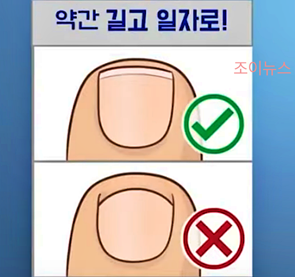 내성발톱 발톱 관리_출처:김범수교수의발편한세상