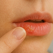 입술에 물집이 생기는 이유