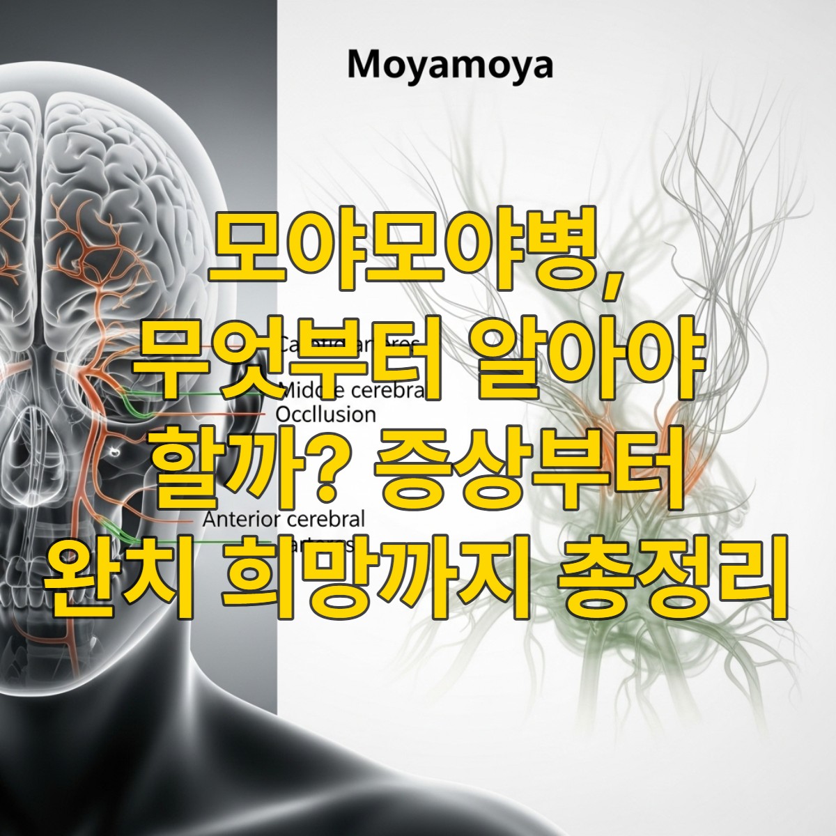 뇌혈관 협착과 모야모야 혈관으로 불리는 미세 혈관망이 보이는 사람의 두개골 내부를 묘사한 의료 삽화. 모야모야병의 특징을 시각적으로 보여줍니다.