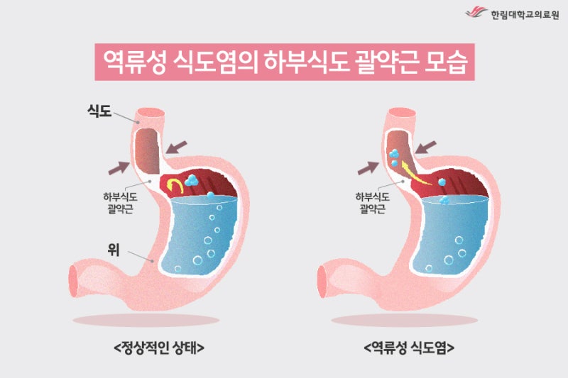 음주가 역류성 식도염을 악화시키는 이유 이미지
