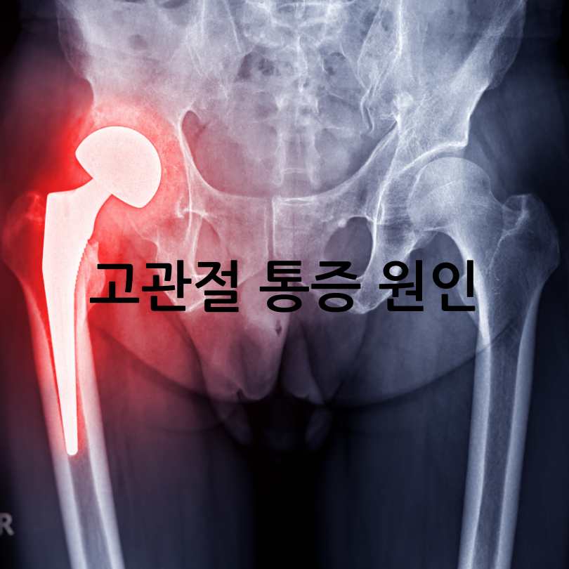 고관절통증 증상 관리법