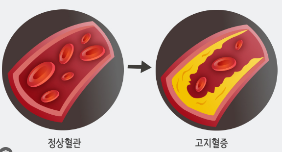 고지혈증