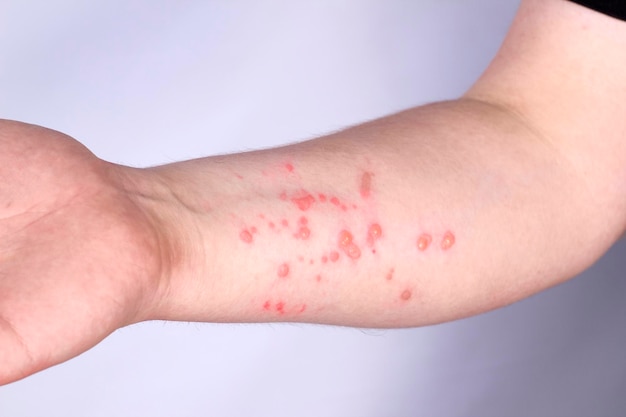 chickenpox symptoms 5