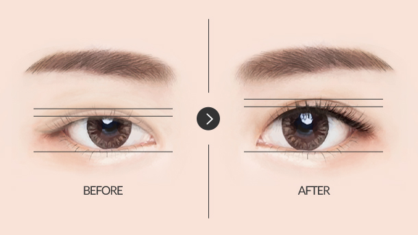 여자 무쌍 눈매 교정