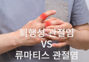 류마티스로 아픈 손가락