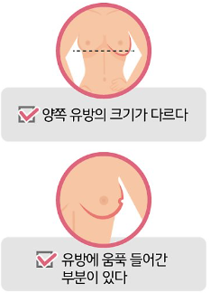 유방암 증상