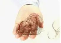 머리카락이 빠지고 정수리가 보이면 여성 탈모 진행별 증상과 해결책