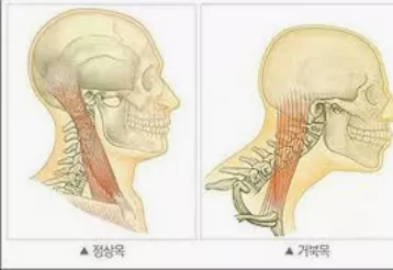 거북목-교정운동-거북목-증상-건강